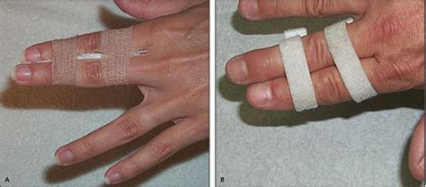 Acute Finger Injuries: Part I. Tendons and Ligaments | AAFP