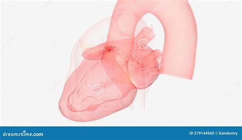 The Left Atrial Appendage Thrombus Stock Illustration - Illustration of ...