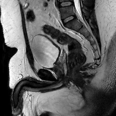 Prostate MRI protocol | Radiology Reference Article | Radiopaedia.org