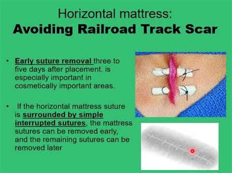 11 horizontal Mattress Sutures - YouTube