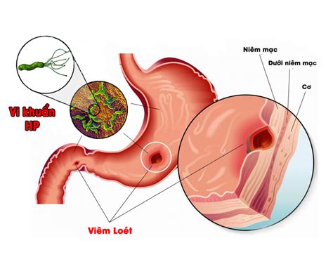 Bệnh đau dạ dày - Nguyên nhân, Triệu chứng và Cách điều trị - Nhà Thuốc Đông Nam Dược Minh Nhi