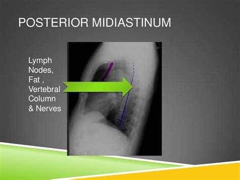 CT ANATOMY OF NORMAL MEDIASTINUM MADE EASY