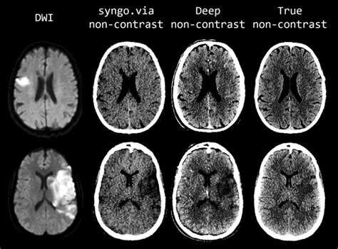 Comparison of representative examples of diffusion-weighted images... | Download Scientific Diagram