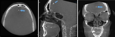 Calcification of the falx in an axial view. Center. In a sagittal view.... | Download Scientific ...