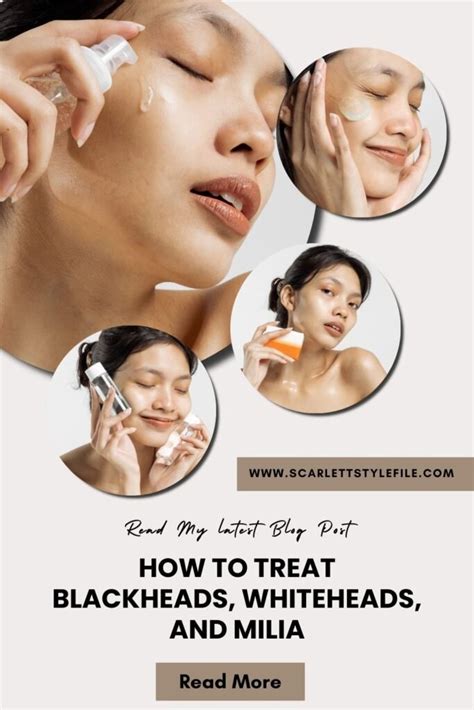 How To Treat Blackheads, Whiteheads, and Milia: Effective Treatments ...