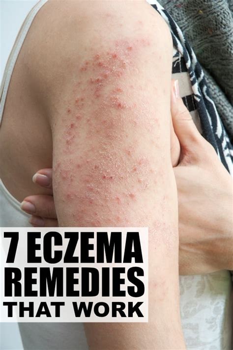 7 eczema remedies that work