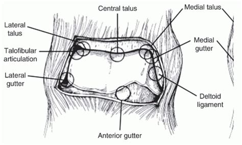 Anterior Ankle Arthroscopy: Indications and Surgical Techniques ...