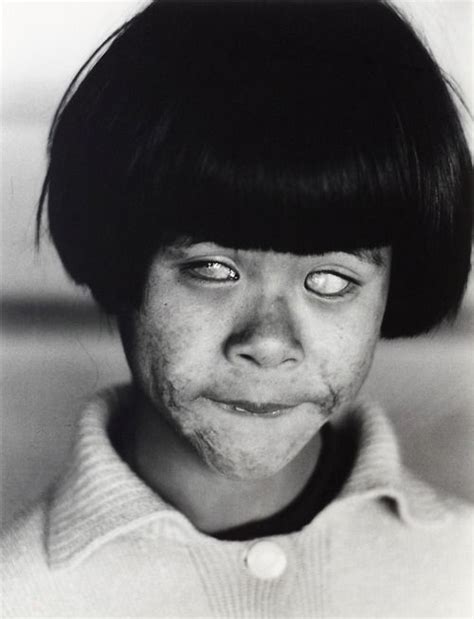 This is an image of a little girl affected by the Hiroshima bombing ...