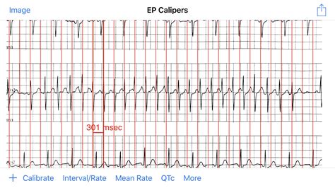 PSVT or PAT? : r/Cardiology