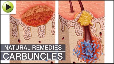 Home Remedies for Carbuncles - YouTube