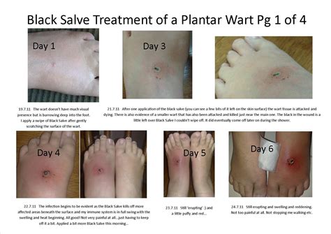 Holistic Therapy Connections: Treatment of a Plantar Wart using Black Salve