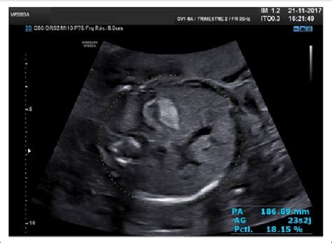 Echogenic bowel visualized in 2D ultrasound secondary to a probable... | Download Scientific Diagram