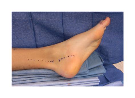 Tarsal Tunnel Release | Surgical Education / Learn Surgery | Washington ...