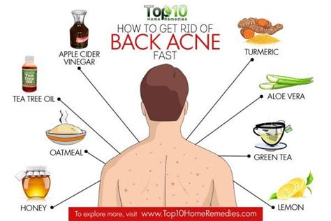 How to Get Rid of Back Acne Fast | Top 10 Home Remedies