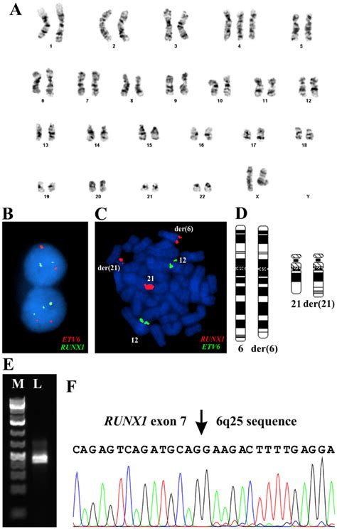 G-banding, FISH and RT-PCR analyses at diagnosis. (A) The G-banding... | Download Scientific Diagram