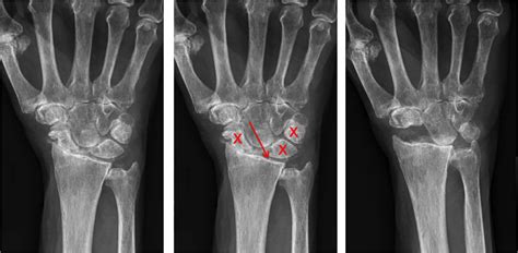 Wrist Arthritis - Raleigh Hand Surgery — Joseph J. Schreiber, MD