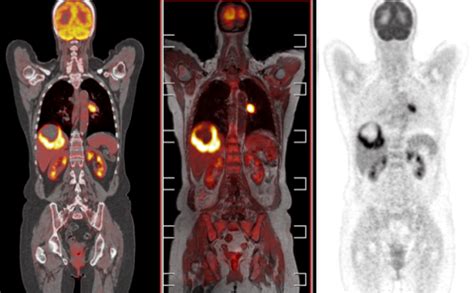 Example of molecular imaging techniques (Left to right: PET-CT, PET-MR ...