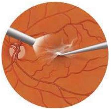 Macular Pucker - Macula Retina Vitreous Center