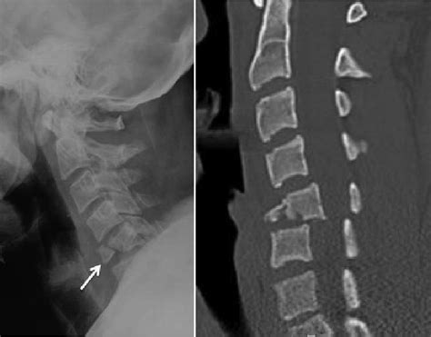 Flexion Teardrop Fracture