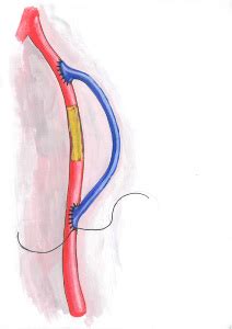 North America Vascular Graft Market Analysis 2017-2023 – ResearchAndMarkets.com – Cardiac ...