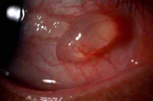 Cyst on Eyeball, Inside, behind, Causes, Pictures, Dermoid, Small Clear Cyst, Conjunctival, NHS ...