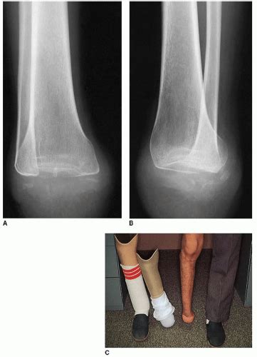 Syme Ankle Disarticulation Amputation | Musculoskeletal Key