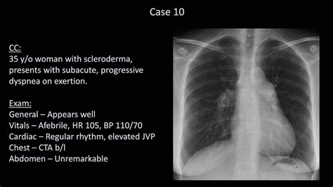 How To Interpret A Chest X Ray Lesson Diffuse Lung Processes Youtube ...