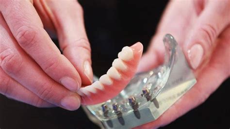 Snap on Dentures vs Implant Dentures - Affordable Implants