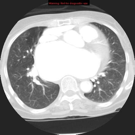 Left atrial enlargement | Radiology Case | Radiopaedia.org