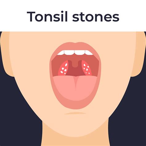 Do You Have Tonsil Stones? Causes, Symptoms & Treatments, With Puyallup ...