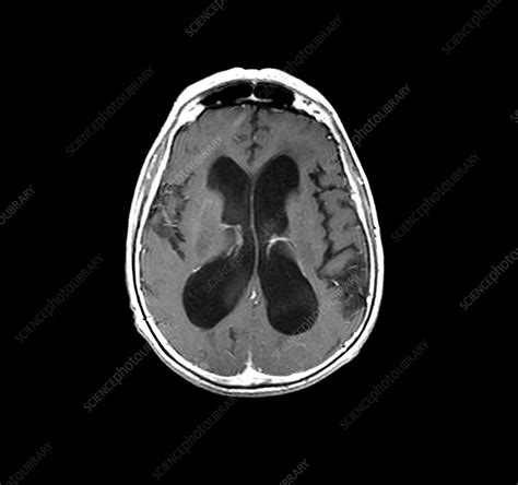 MRI of hydrocephalus - Stock Image - M170/0369 - Science Photo Library