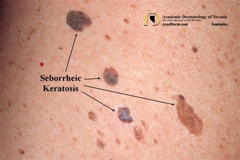 Seborrheic Keratosis: Barnacles of life... - Academic Dermatology of Nevada