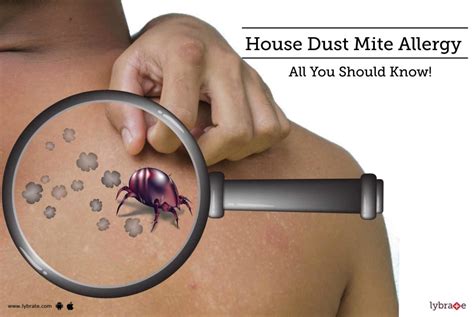 House Dust Mite Allergy - All You Should Know! - By Dr. Roopali Jain Tripathi | Lybrate