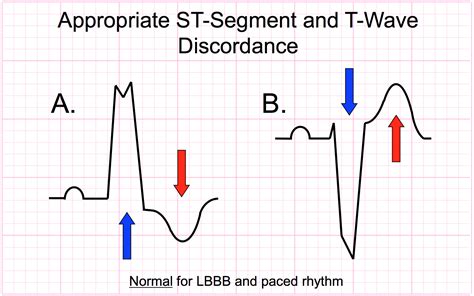 Making Sense of Sgarbossa’s Criteria - Chest Pain and Left Bundle Branch Block – Part 1 - ECG ...