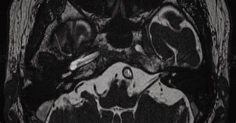 Neuroradiology Cases: Purely Intracanalicular Acoustic Schwannoma MRI