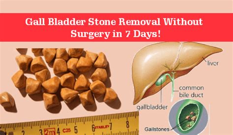 Are you wondering how to dissolve gallstones naturally? Don't worry now ...