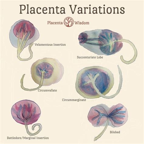 Placenta Variations | Midwifery, Student midwife, Midwifery student