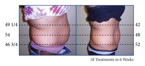 Non Invasive Laser Lipo - Medshape Weight Loss Clinics