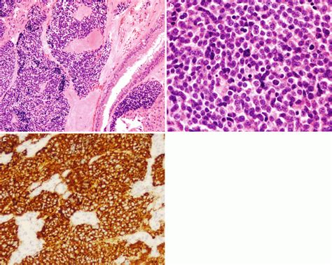 Olfactory Neuroblastoma and Sellar Neuroblastoma | Neupsy Key