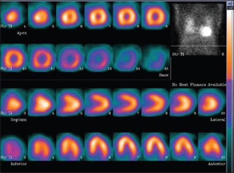 Exercise thallium SPECT images show diffuse thallium up | Open-i