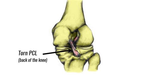 Posterior Cruciate Ligament Injury (Torn PCL) - Symptoms & rehabilitation