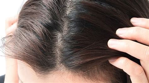 Troubled by pimples on your scalp? Here's how to get rid of them | Health - Hindustan Times