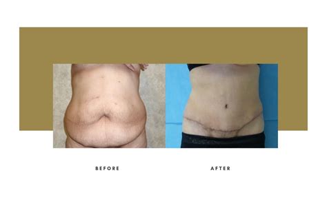 Abdominoplasty Beverly Hills | Julie Edween D.O.