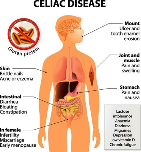 Celiac disease: MedlinePlus Genetics