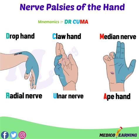 Nerve Palsies of Hand Mnemonic – MedicoLearning