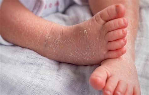 Ichthyosis Vulgaris: Causes, Symptoms, Diagnosis, & Treatment