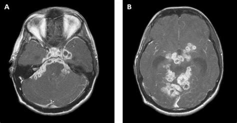 Tuberculous Meningitis: The Critical Issues | Neupsy Key