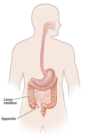 Appendicitis | Cedars-Sinai