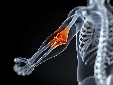 Overview of Inflammatory Arthritis