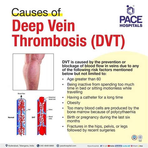 Deep Vein Thrombosis, DVT Symptoms, Causes And, 43% OFF